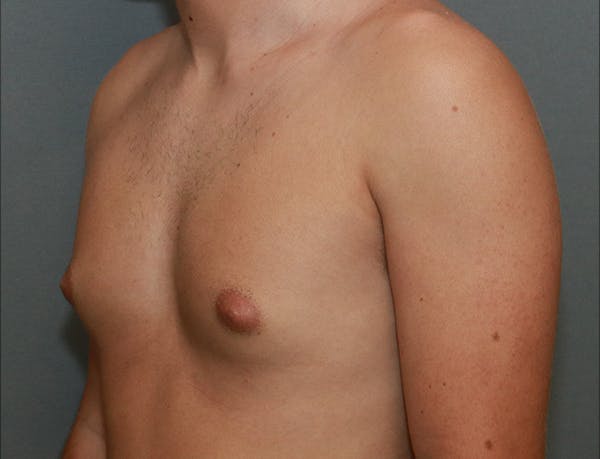 Gynecomastia Before & After Gallery - Patient 8284604 - Image 3