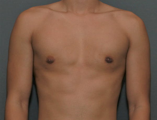 Gynecomastia Before & After Gallery - Patient 7329085 - Image 2