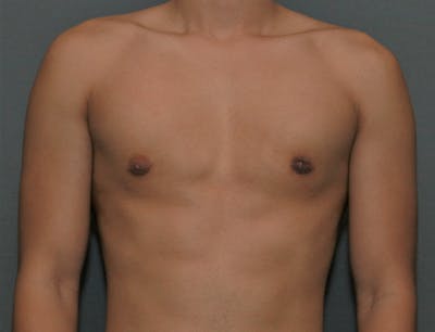 Gynecomastia Before & After Gallery - Patient 7329085 - Image 2
