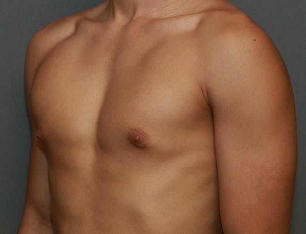 Gynecomastia Before & After Gallery - Patient 8284605 - Image 3