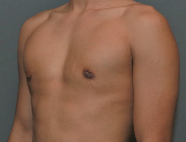 Gynecomastia Before & After Gallery - Patient 8284605 - Image 4