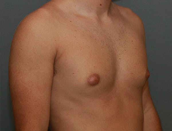 Gynecomastia Before & After Gallery - Patient 7329084 - Image 5