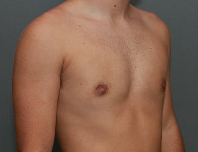 Gynecomastia Before & After Gallery - Patient 8284604 - Image 6