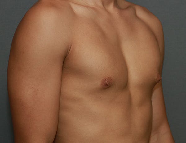 Gynecomastia Before & After Gallery - Patient 7329085 - Image 5