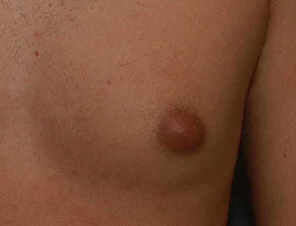 Gynecomastia Before & After Gallery - Patient 8284604 - Image 7