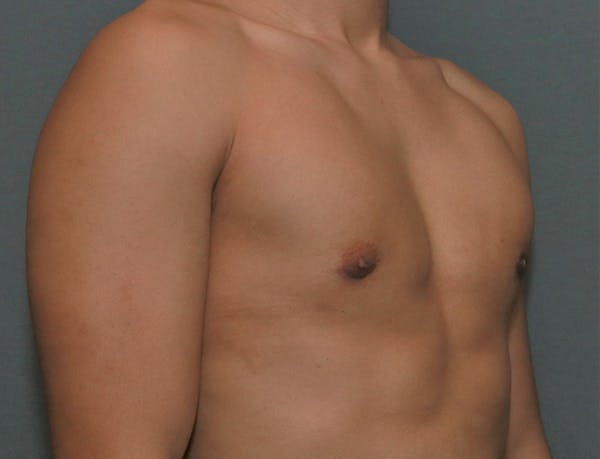 Gynecomastia Before & After Gallery - Patient 8284605 - Image 6
