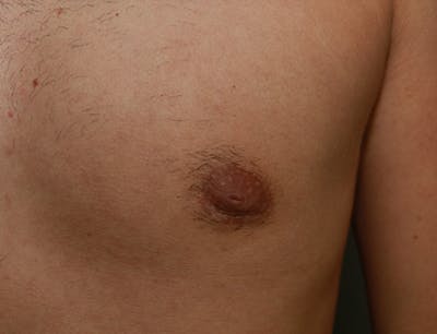 Gynecomastia Before & After Gallery - Patient 7329084 - Image 8