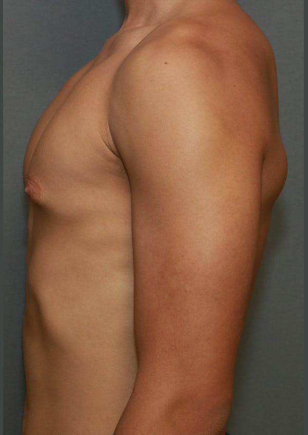 Gynecomastia Before & After Gallery - Patient 8284605 - Image 7