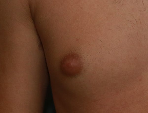 Gynecomastia Before & After Gallery - Patient 7329084 - Image 9