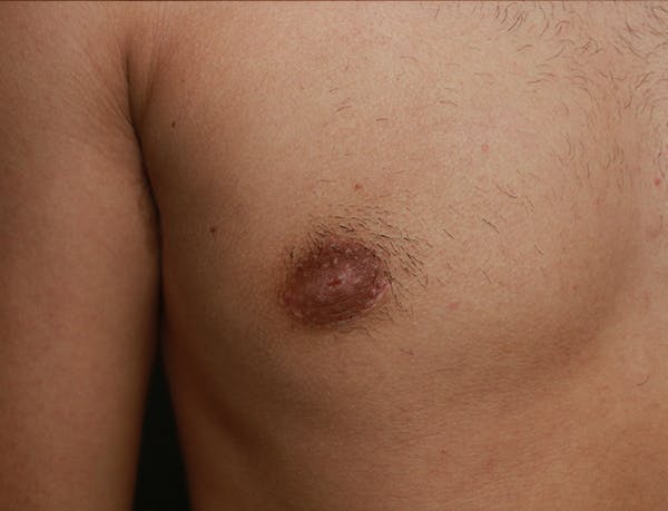 Gynecomastia Before & After Gallery - Patient 7329084 - Image 10