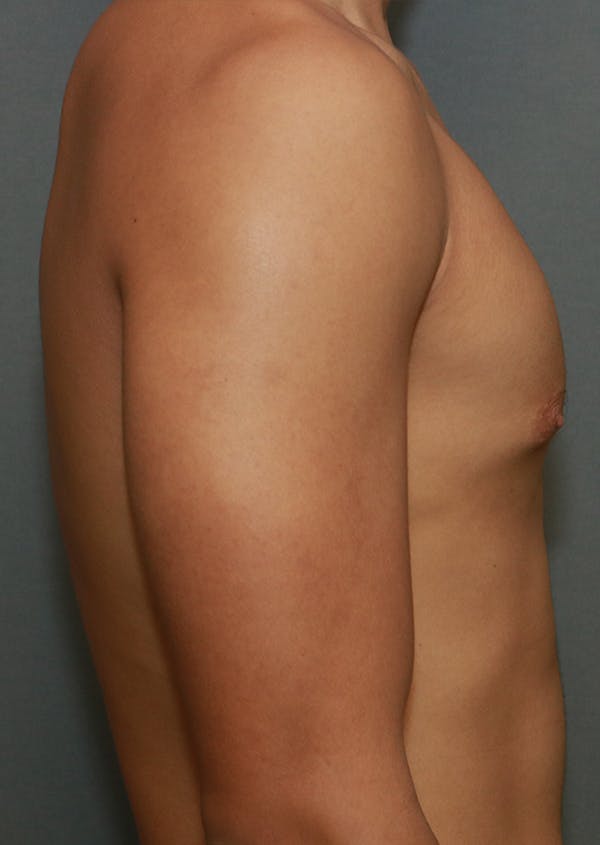 Gynecomastia Before & After Gallery - Patient 7329085 - Image 9