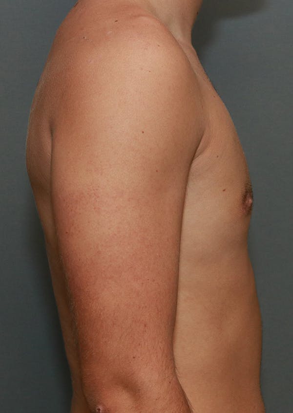 Gynecomastia Before & After Gallery - Patient 7329084 - Image 11