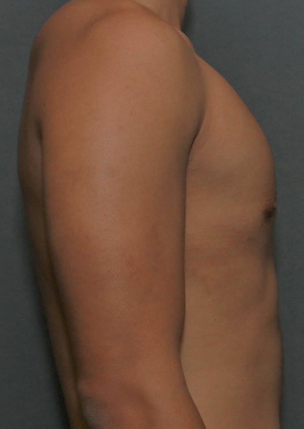 Gynecomastia Before & After Gallery - Patient 7329085 - Image 10