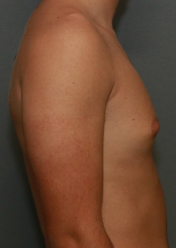 Gynecomastia Before & After Gallery - Patient 7329084 - Image 12