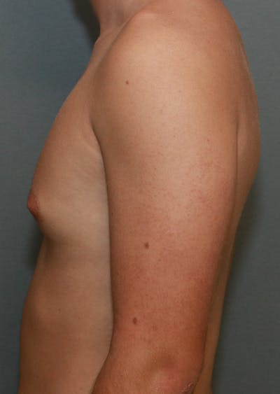 Gynecomastia Before & After Gallery - Patient 7329084 - Image 14