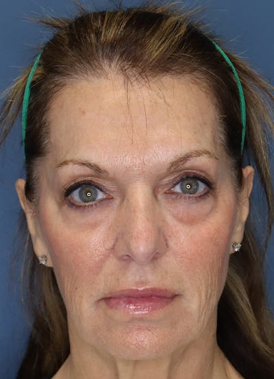 Facelift Before & After Gallery - Patient 7369036 - Image 1