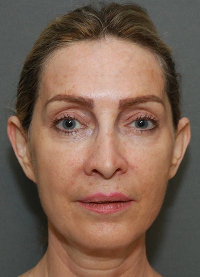 Facelift Before & After Gallery - Patient 7369037 - Image 1