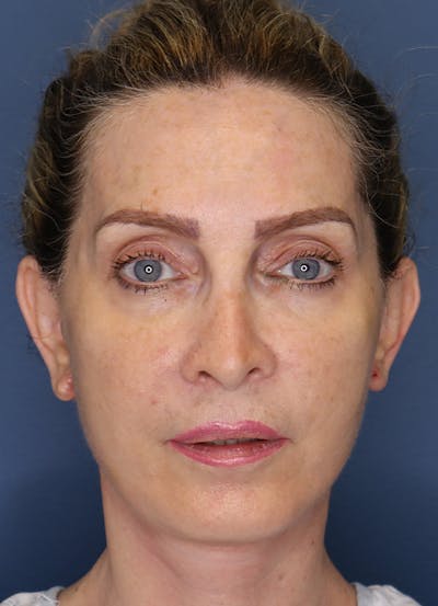 Facelift Before & After Gallery - Patient 7369037 - Image 2