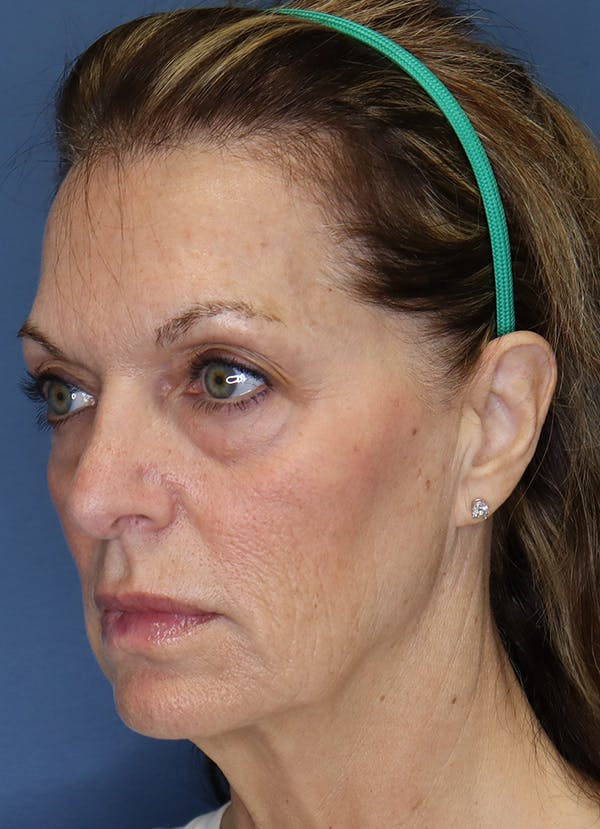 Facelift Before & After Gallery - Patient 7369036 - Image 3