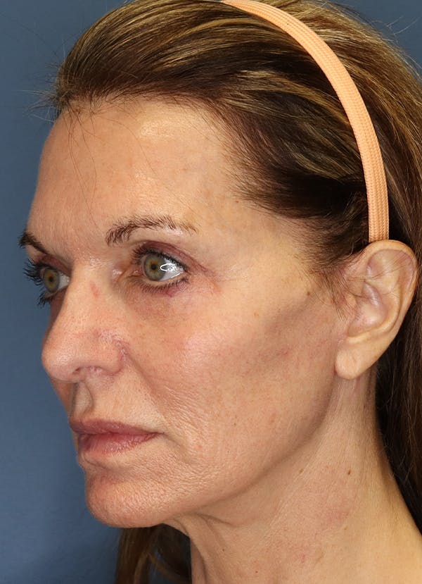 Facelift Before & After Gallery - Patient 7369036 - Image 4
