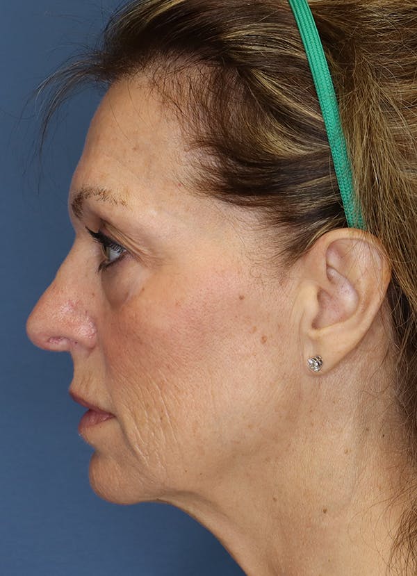 Facelift Before & After Gallery - Patient 7369036 - Image 5