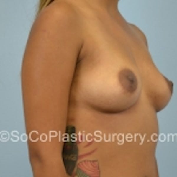 Breast Augmentation Before & After Gallery - Patient 7809553 - Image 3