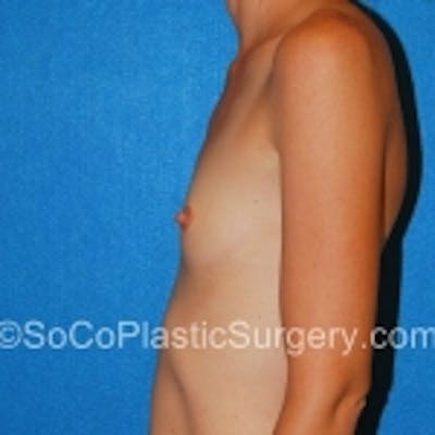 Breast Augmentation Before & After Gallery - Patient 7809558 - Image 1