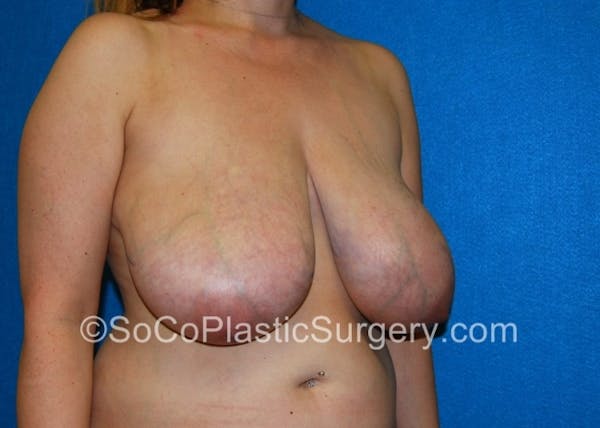 Breast Lift Before & After Gallery - Patient 8281894 - Image 3