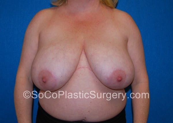 Breast Lift Before & After Gallery - Patient 8281899 - Image 1