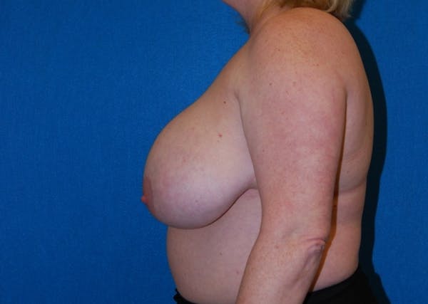 Breast Lift Before & After Gallery - Patient 8281899 - Image 3