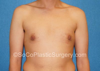 Gynecomastia Before & After Gallery - Patient 8284569 - Image 2