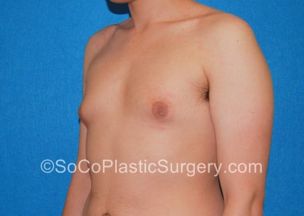 Gynecomastia Before & After Gallery - Patient 8284606 - Image 3