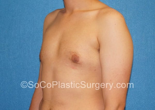 Gynecomastia Before & After Gallery - Patient 8284569 - Image 4