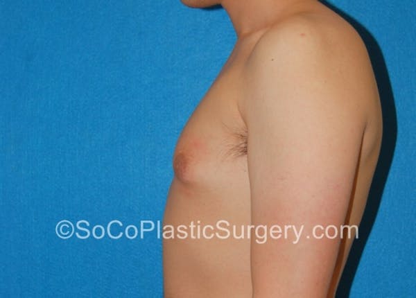 Gynecomastia Before & After Gallery - Patient 8284606 - Image 5