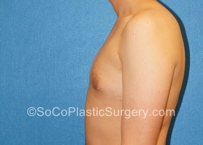 Gynecomastia Before & After Gallery - Patient 8284606 - Image 6