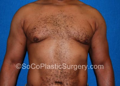 Gynecomastia Before & After Gallery - Patient 8284607 - Image 2