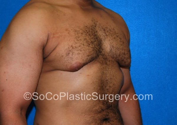 Gynecomastia Before & After Gallery - Patient 8284570 - Image 3
