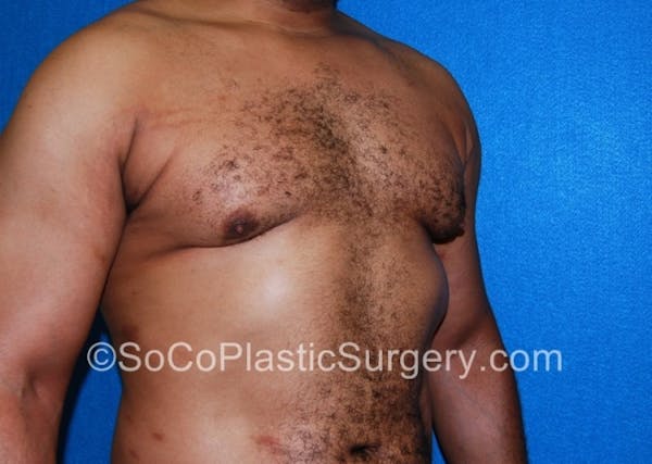 Gynecomastia Before & After Gallery - Patient 8284607 - Image 4