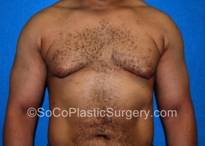 Gynecomastia Before & After Gallery - Patient 8284607 - Image 1