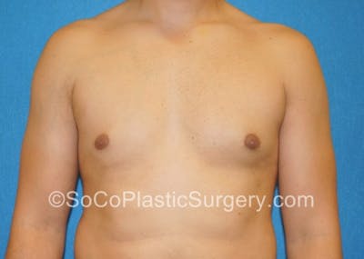 Gynecomastia Before & After Gallery - Patient 8284571 - Image 2