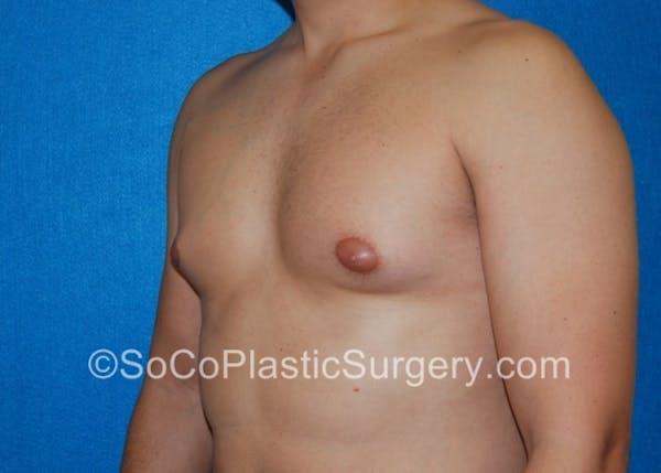 Gynecomastia Before & After Gallery - Patient 8284571 - Image 3