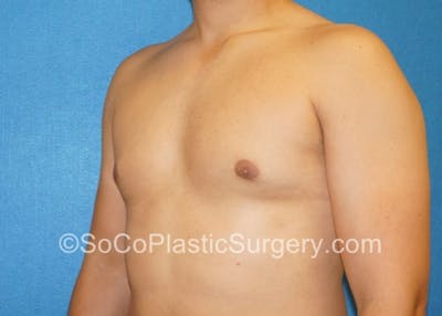 Gynecomastia Before & After Gallery - Patient 8284571 - Image 4