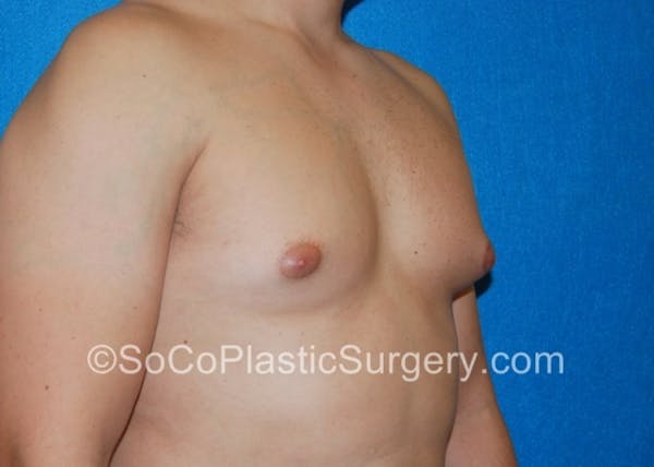 Gynecomastia Before & After Gallery - Patient 8284608 - Image 5