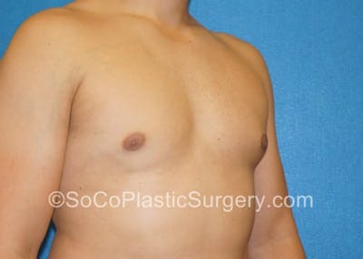 Gynecomastia Before & After Gallery - Patient 8284608 - Image 6