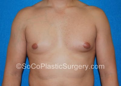 Gynecomastia Before & After Gallery - Patient 8284608 - Image 1