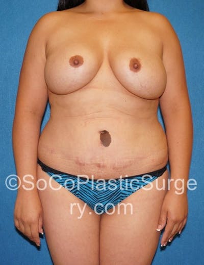 Mommy Makeover Before & After Gallery - Patient 8286134 - Image 1