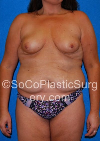 Mommy Makeover Before & After Gallery - Patient 8286136 - Image 1