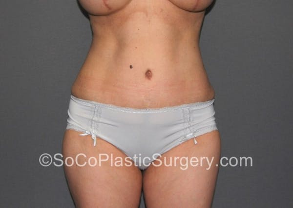 Tummy Tuck Before & After Gallery - Patient 8286183 - Image 4
