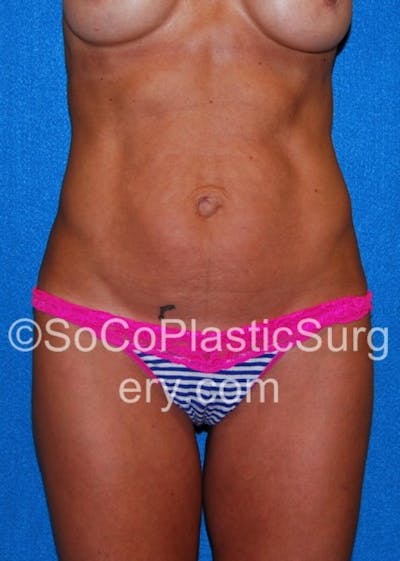 Tummy Tuck Before & After Gallery - Patient 8286185 - Image 1