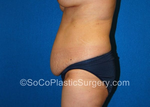 Tummy Tuck Before & After Gallery - Patient 8286183 - Image 5